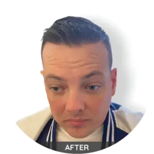 hairline after his hair transplant