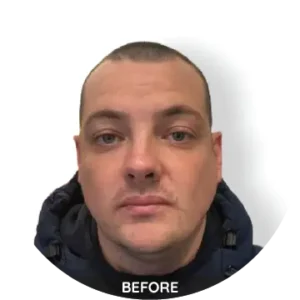 before hair transplant