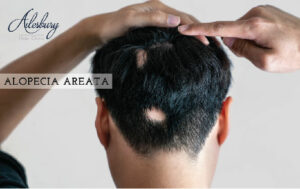 alopecia areata in men