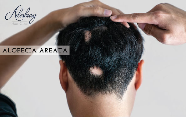 the back of a head with gaps in the hair showing how alopecia areata affects the hair