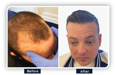 reslts of hair transplant