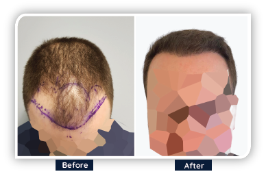 a guy showing the before and after his hair transplant in Ailesbury Hair Clinic in Dublin