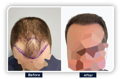 hair transplant