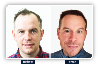 a guy showing the before and after his hair transplant in Ailesbury Hair Clinic in Dublin. On the right it is his head being bald, on the left it is his head with full of hair.