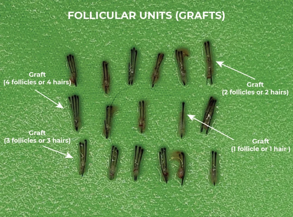 follicles from a hair transplant procedure in Ailesbury Hair Clinic in Dublin