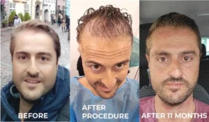 a client of Ailesbury Hair Clinic, showing himself of the before, directly after procedure and after eleven months from his hair transplant