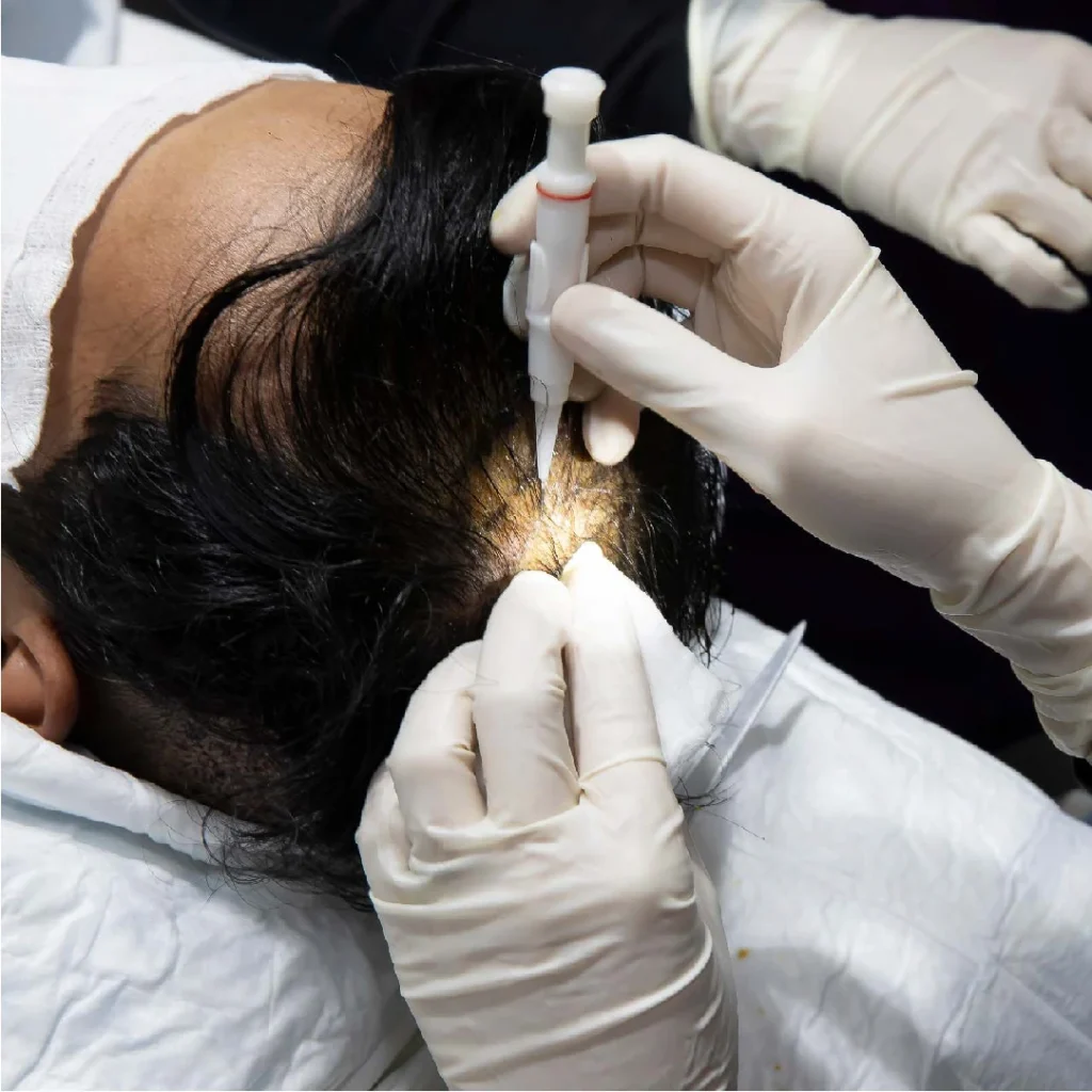a hair transplant doctor doing the surgery on the top of the head of the patient