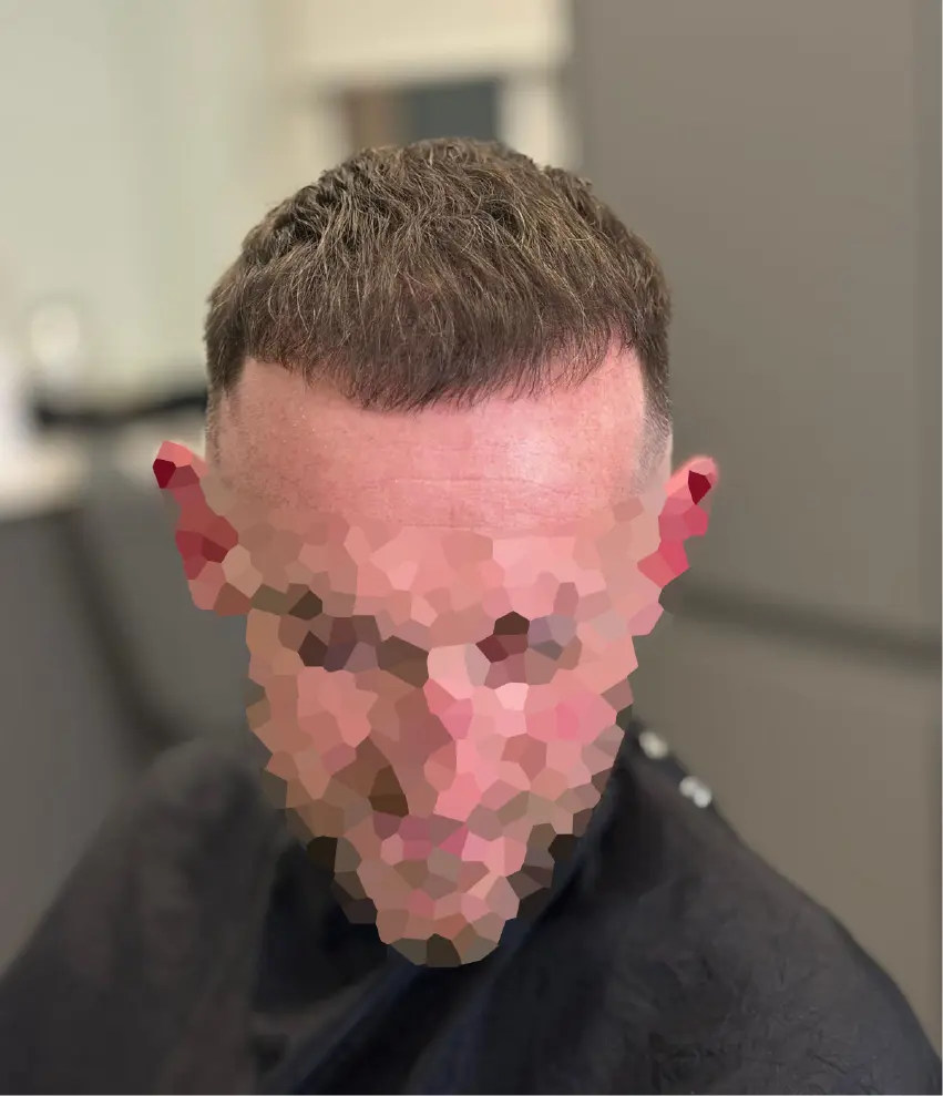 After an AHI Hair transplant procedure