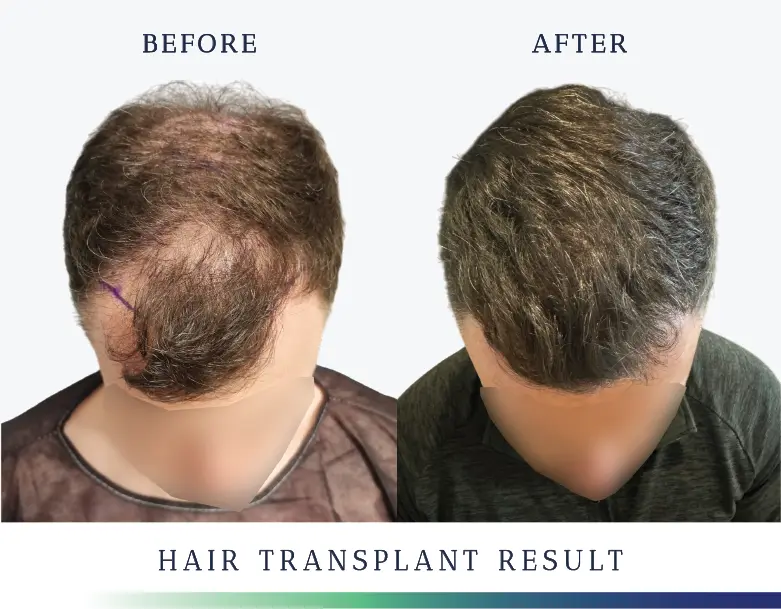 Hair Transplant Results
