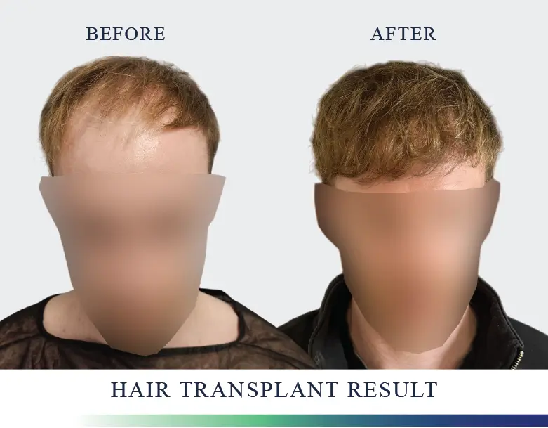 Hair Transplant Results
