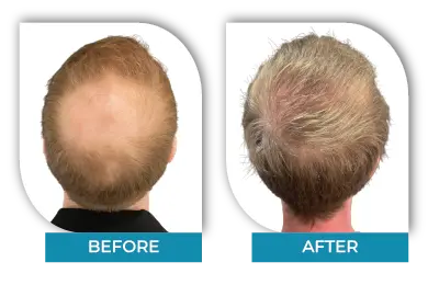Long-term hair transplant results before and after in Dublin
