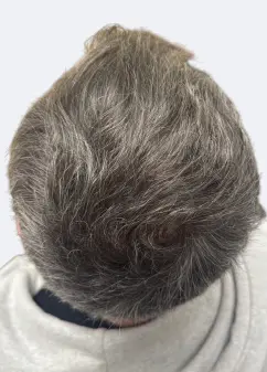 Patient after non-surgical laser hair restoration treatment in Dublin showing post-treatment hair improvement.