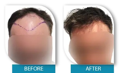 Hair transplant results after 6 months in Dublin before and after