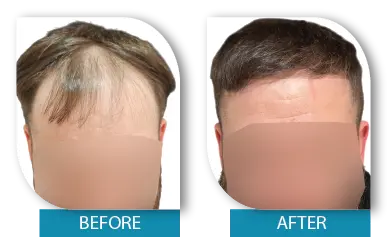 Real patient hair loss before and after results in Dublin