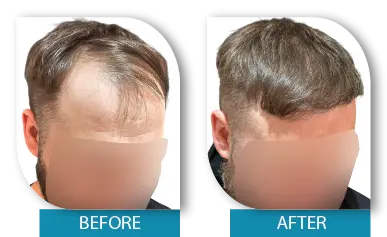 Hair transplant transformation before and after Dublin Ireland
