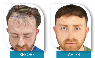 Severe hair thinning before and after treatment in Dublin