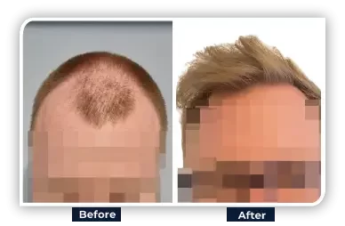 BEFORE AFTER_treatment results